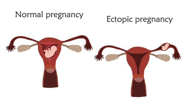 حمل خارج الرحم