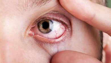 أمراض قرنية العين
